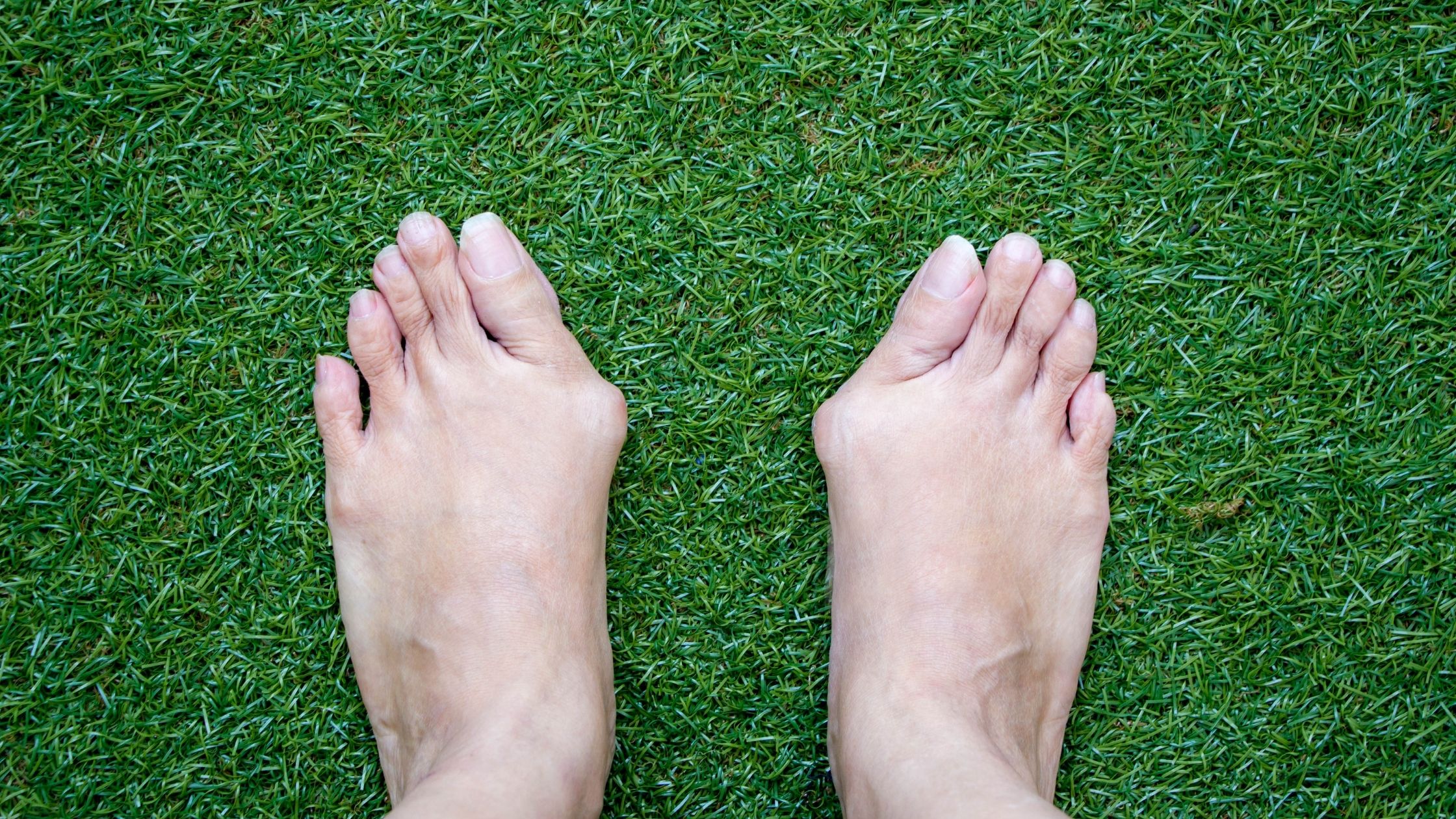 Complications of a foot bunion on feet